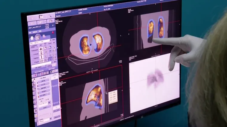 Sve posljedice koronavirusa: Svakom trećem teže oboljelom ispada kosa, 1 posto doživi infarkt, stradavaju bubrezi, jetra i pamćenje