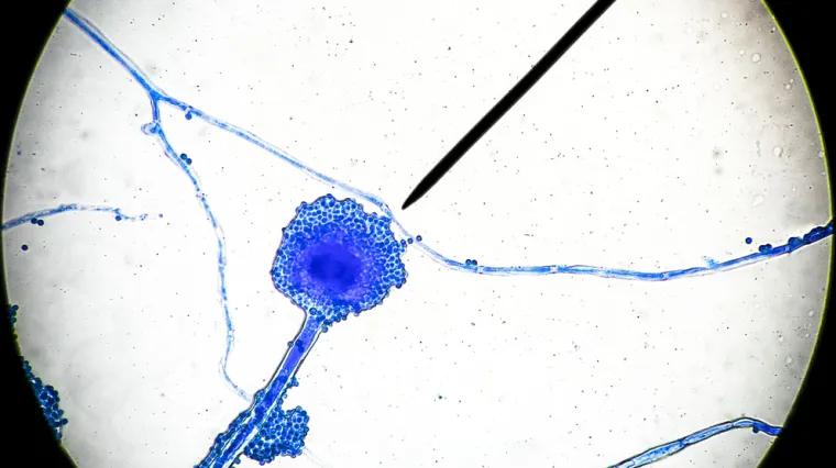 Opasna crna gljivica napada one koji su preboljeli covid - mnogima moraju odstraniti oči: 'Ovo je prava noćna mora'