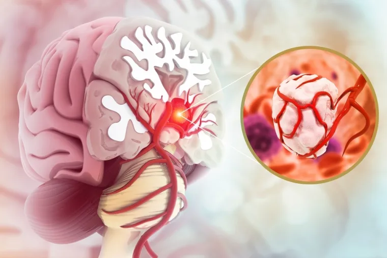 I dobroćudni tumor na mozgu može biti fatalan. Liječnici: 'Ove su skupine pod većim rizikom'