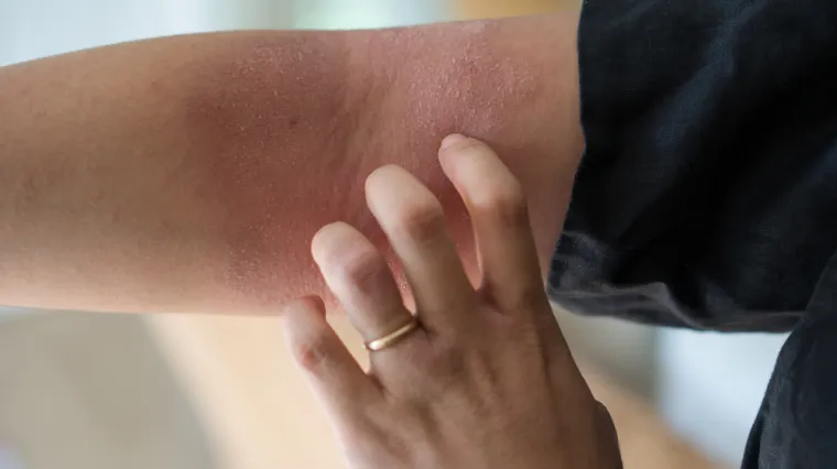 Li&scaron;aj na koži