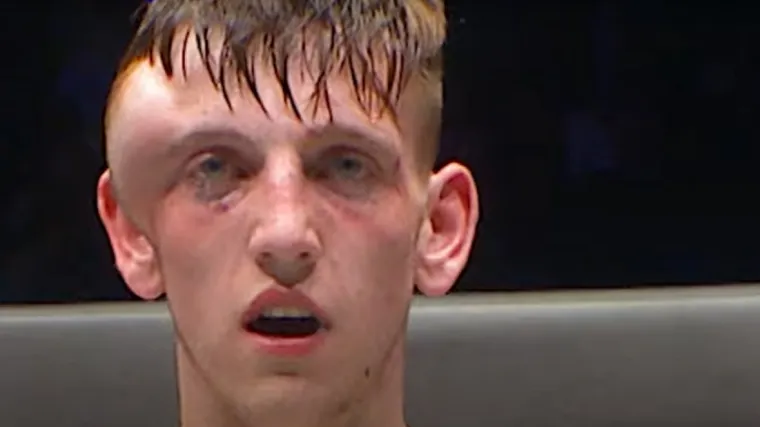 Hrabri borac zadobio užasnu ozljedu: Stvorila mu se doslovno druga glava; 'Pa kako još stoji?'