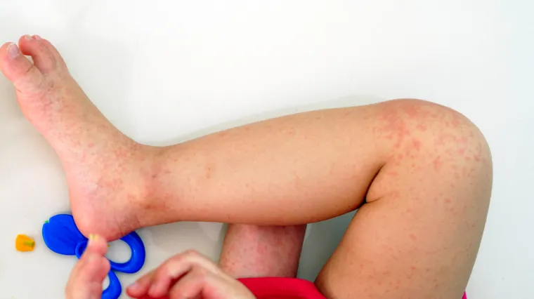 Šesta bolest - Simptomi i liječenje