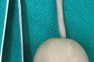 Beba rođena s repom od 12 centimetara koji ima na kraju tkivo u obliku lopte