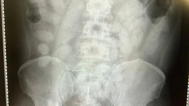 Crijeva i želuca punih kokaina putovao BUS-om za Hrvatsku iz Bruxellesa, uhvatili ga u Njemačkoj