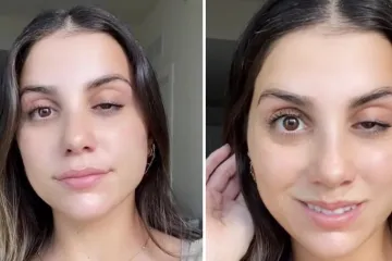 Ubrizgala botoks u čelo, ali on se izlio na pogrešno mjesto: Sada više ne može otvoriti oko