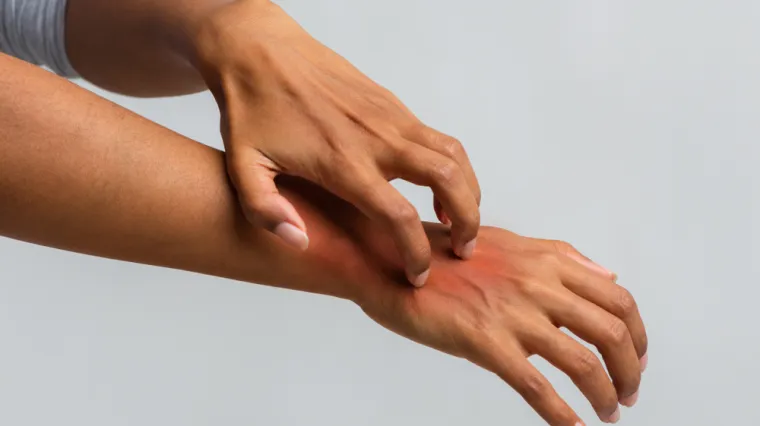 Bolovi, otekline i deformacije u psorijatičnom artritisu negativno utječu na kvalitetu života