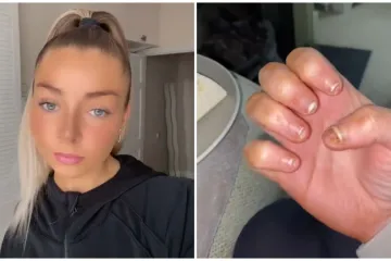 Nakon skidanja geliranih noktiju završila s infekcijom na Hitnoj: 'Ako ste gadljivi, nemojte ovo gledati'