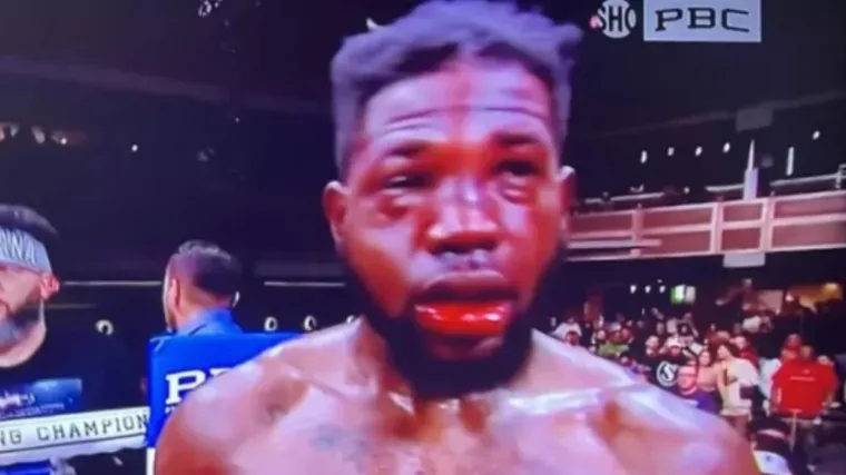 Lice boksača potpuno unakaženo: Izgleda neprepoznatljivo nakon &scaron;to je primio 255 udaraca u glavu