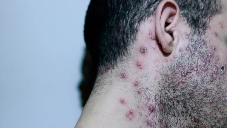 Srbija potvrdila prvi slučaj majmunskih boginja: Zavod za virusologiju objavio važnu poruku građanima