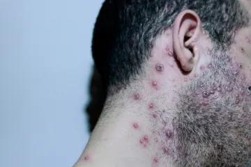 Srbija potvrdila prvi slučaj majmunskih boginja: Zavod za virusologiju objavio važnu poruku građanima