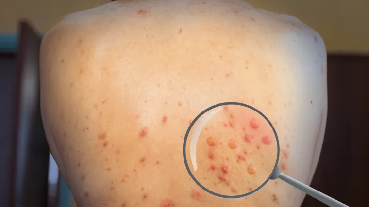 U Srbiji potvrđen prvi slučaj majmunskih boginja: 'Građane molimo da se pridržavaju mjera i preporuka'