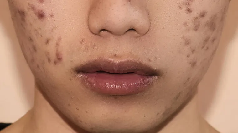 Znate li što se događa vašoj koži kad prestanete jesti sol? Dobro je smanjiti konzumaciju, ali ipak nemojte pretjerati. Evo zašto