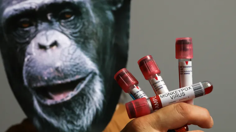 WHO zbog majmunskih boginja želi da se proglasi izbijanje izvanrednog stanja: 'Vi&scaron;e od 80% slučajeva je iz Europe'