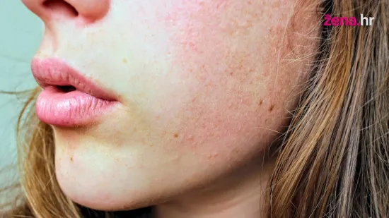 Dr. Kolić o atopijskom dermatitisu kod odraslih