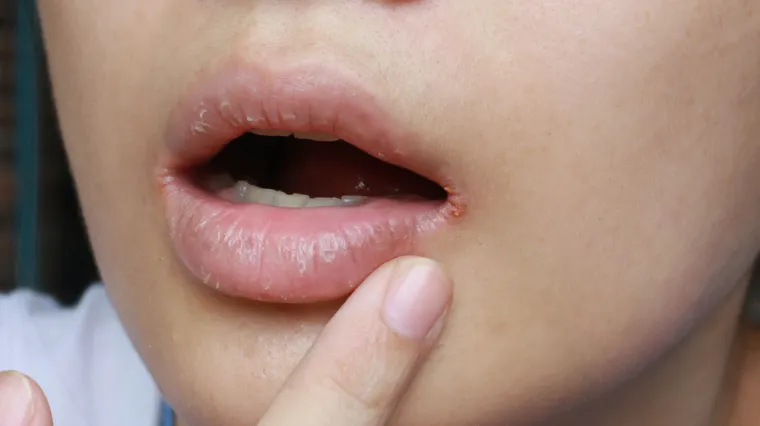 Stomatolog savjetuje da obratite pozornost na suha usta: To može biti znak pet ozbiljnih bolesti