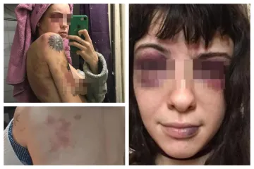 Ruskinja brutalno pretučena u Srbiji: Prebio svoju djevojku (19), uzeo joj ušteđevinu i pobjegao iz zemlje