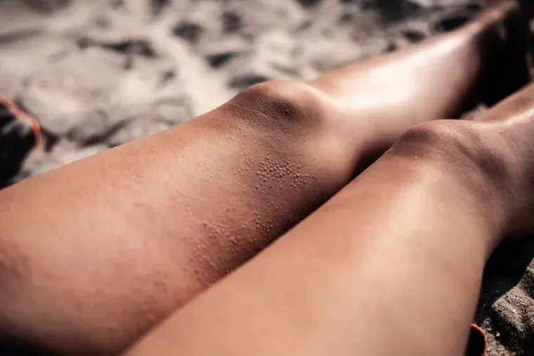 Kako prepoznati alergiju na sunce? Donosimo prirodne načine za liječenje