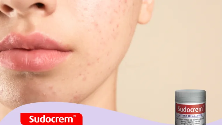 Sudocrem kao najbolje čuvana beauty tajna