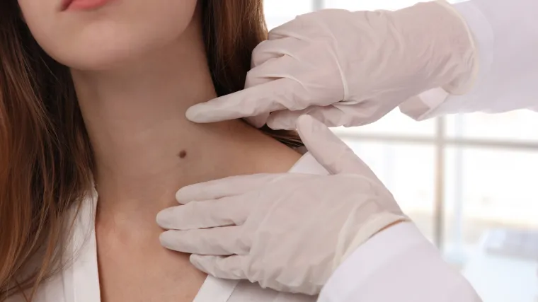 Kreću besplatni pregledi madeža: Evo u kojih &scaron;est gradova će vas čekati dermatolozi!