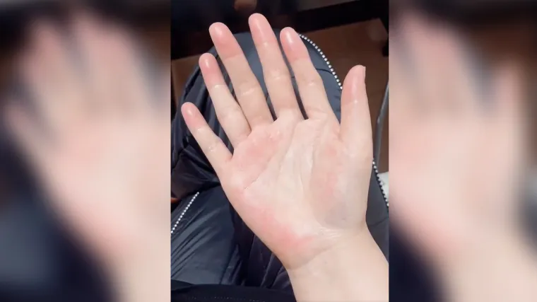 Rođena je sa &scaron;est prstiju: Fenomen se spominje u Bibliji, a intrigira i kako ga tumače praznovjerni