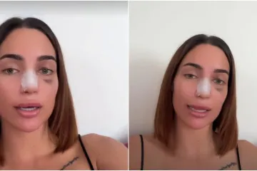 Laura otkrila da je bila na operaciji i usporedila svoje fotografije prije i nakon: 'Radite korekcije zbog sebe'