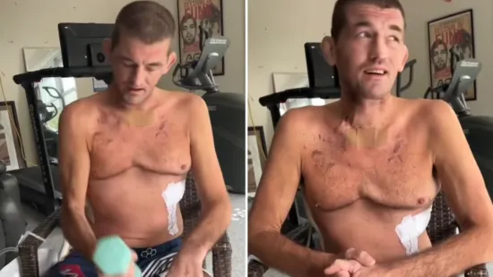 Jao, je li ovo moguće? Ben Askren otkrio potresne posljedice transplantacije pluća i pokazao tijelo