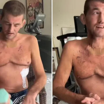 Jao, je li ovo moguće? Ben Askren otkrio potresne posljedice transplantacije pluća i pokazao tijelo