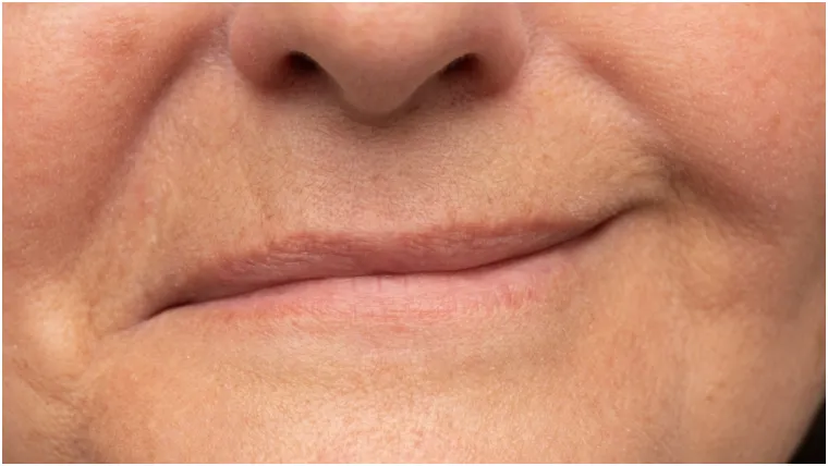 Medeni mjesec iz pakla: Stres zbog otkazanog krstarenja izazvao joj je paralizu lica