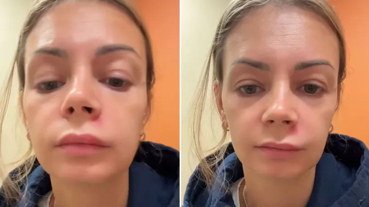 Kopala po prištiću, pa joj se paraliziralo lice: 'Istiskivanje u Trokutu smrti je opasno'