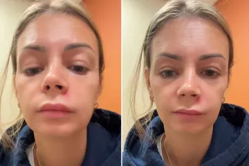 Kopala po prištiću, pa joj se paraliziralo lice: 'Istiskivanje u Trokutu smrti je opasno'