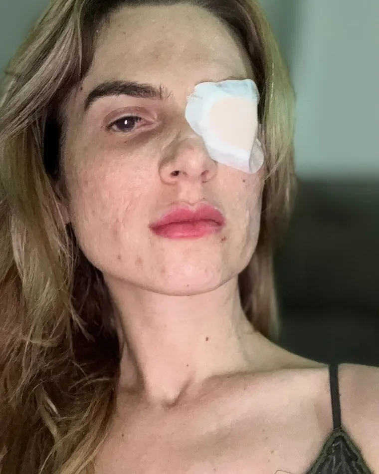 Nakon što je popila ibuprofen za menstrualne bolove, ostala je gotovo potpuno slijepa