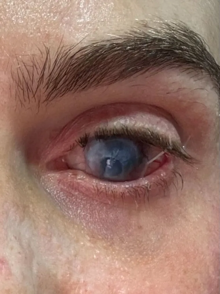 Nakon što je popila ibuprofen za menstrualne bolove, ostala je gotovo potpuno slijepa