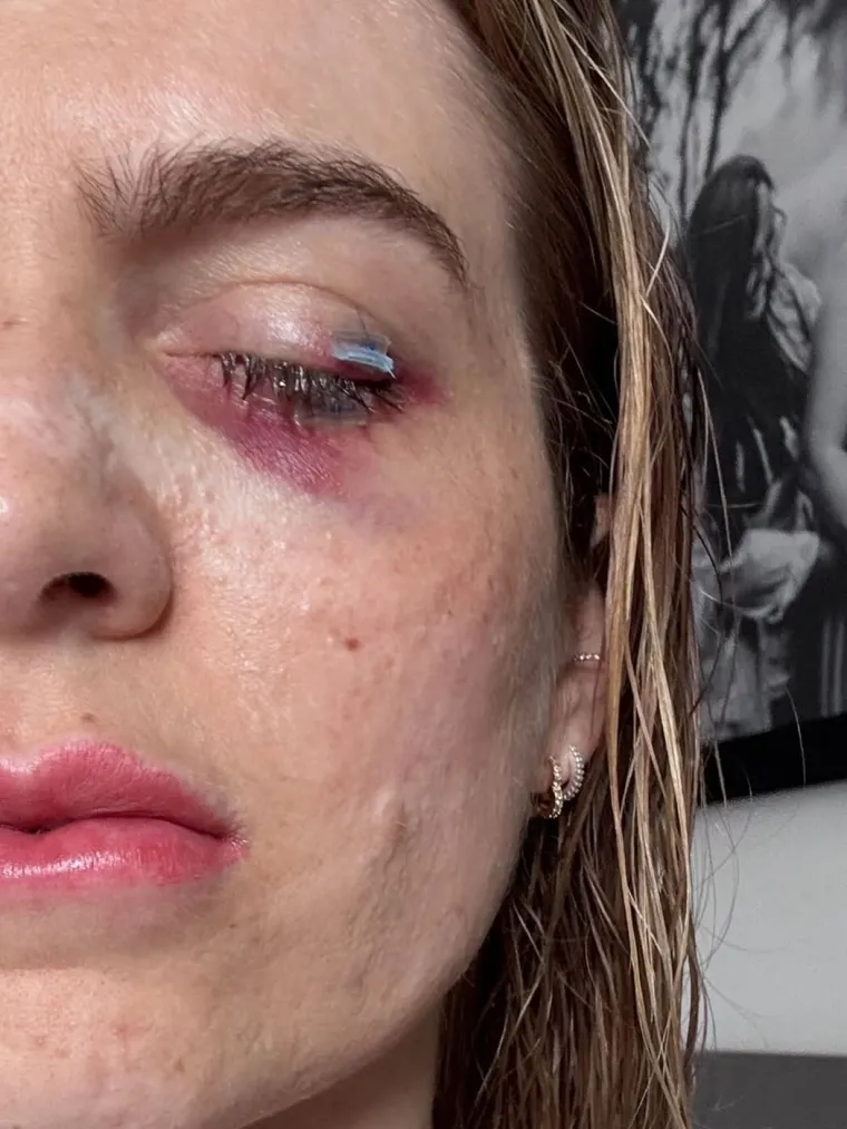 Nakon što je popila ibuprofen za menstrualne bolove, ostala je gotovo potpuno slijepa