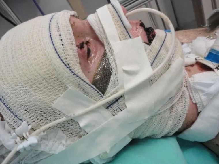 Nakon što je popila ibuprofen za menstrualne bolove, ostala je gotovo potpuno slijepa