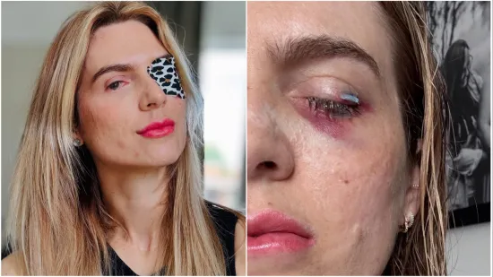 Nakon što je popila ibuprofen za menstrualne bolove, ostala je gotovo potpuno slijepa