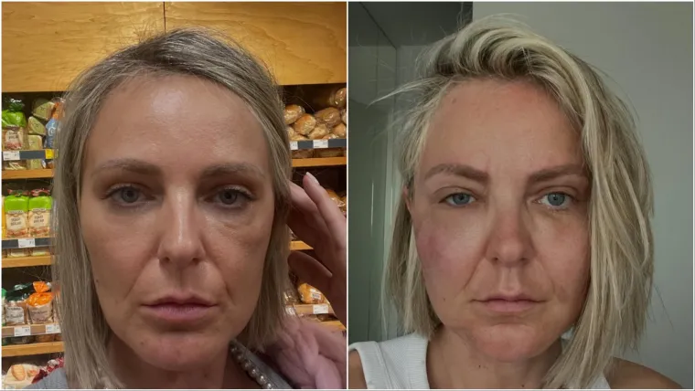 Lice su joj uništili, život je postao pakao, a danas... Pogledajte kako Stankica izgleda