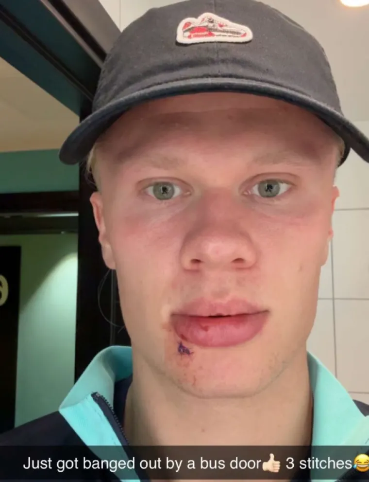 Vozač, može zadnja! Haaland doživio neobičnu ozljedu u autobusu, podijelio fotografije