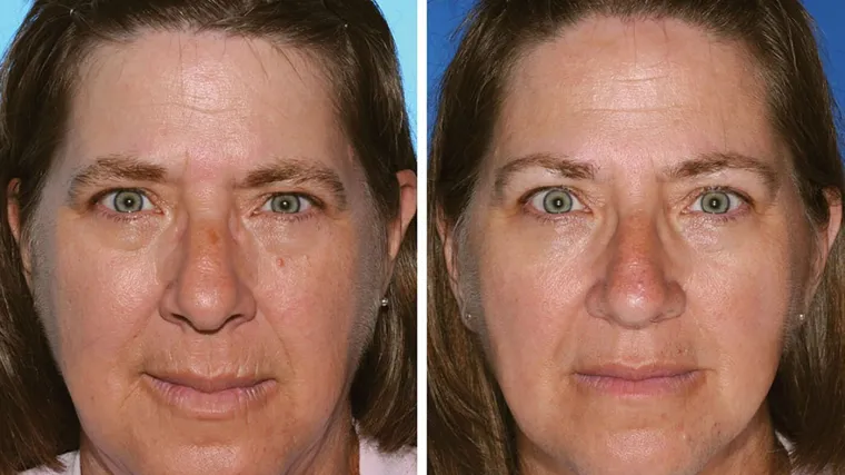 Studije na jednojajčanim blizancima pokazale posljedice pušenja: Razlika vidljiva golim okom