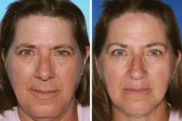 Studije na jednojajčanim blizancima pokazale posljedice pušenja: Razlika vidljiva golim okom