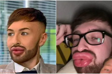 Ovisnost o fileru i botoksu pretvorila ga u patku, a onda je napravio čudo: Sada izgleda kao maneken