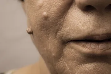 Ima rijetku bolest i živi sa stotinama tumora: Ponosno pokazuje lice unatoč uvredama