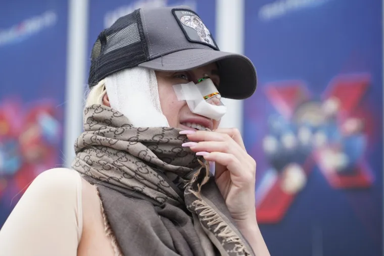 Operirala nos sedam puta, a rezultat je bizaran: Pogledajte kako izgleda voditeljica nakon zahvata