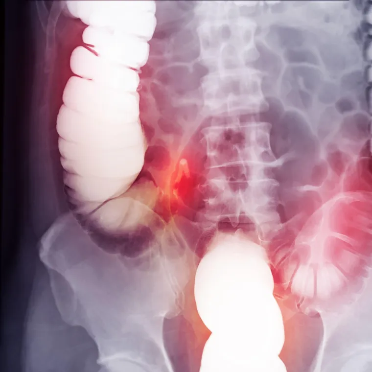 Raste broj slučajeva zaboravljenog raka kod mladih: Simptome je lako zanemariti