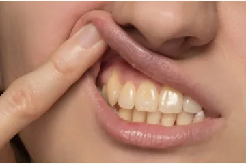 Zubarica objašnjava: 'Iako redovito perete zube, oni su i dalje žuti. Evo zašto'