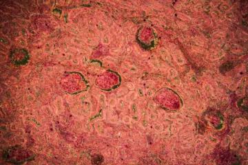 Najsmrtonosnija infekcija na svijetu širi se 'Otokom': 'Kašalj možda nije gripa ili Covid!'