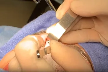 Popularne, ali ne bez rizika: Evo zašto biste trebali razmisliti prije odlaska na plastičnu operaciju