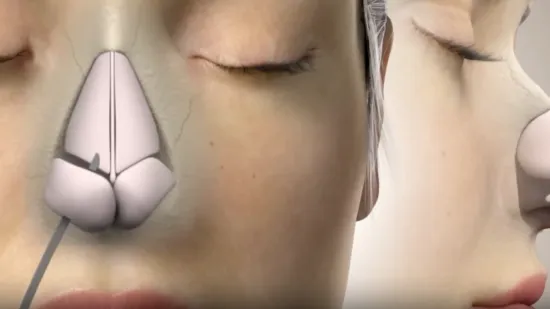 Mnogi ih rade, ali znate li rizike? Stručnjaci upozoravaju: 'Sve izgleda u redu, ali...'