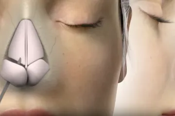 Mnogi ih rade, ali znate li rizike? Stručnjaci upozoravaju: 'Sve izgleda u redu, ali...'