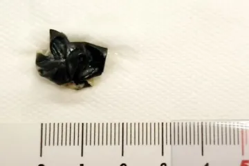 Zadah i upale uha otkrili šokantan uzrok: Pogledajte što je liječnica u Splitu pronašla u nosu dječaka