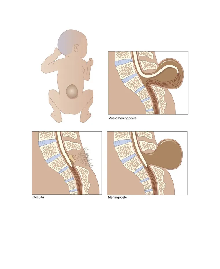 Pedijatrica o malformaciji koja nastaje u trudnoći: 'Simptomi su gotovo neprimjetni'